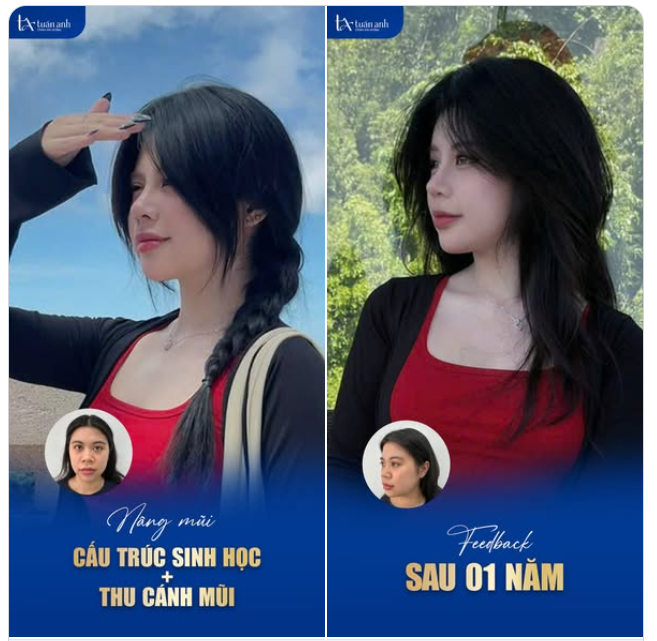 Nhận lịch thăm khám và sở hữu dáng mũi thanh tú chỉ với 19,5 Tr ngay hôm nay!
