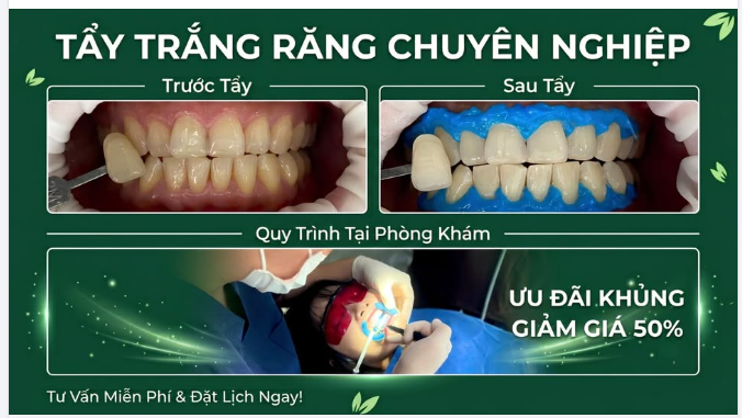 TẨY TRẮNG RĂNG CHUYÊN NGHIỆP – BẬT TONE NỤ CƯỜI CHỈ SAU 1 BUỔI!