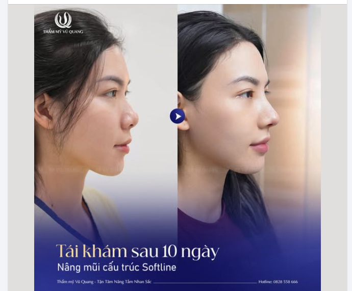 Muốn đổi dáng mũi - đổi thần thái như cô bạn ấy?