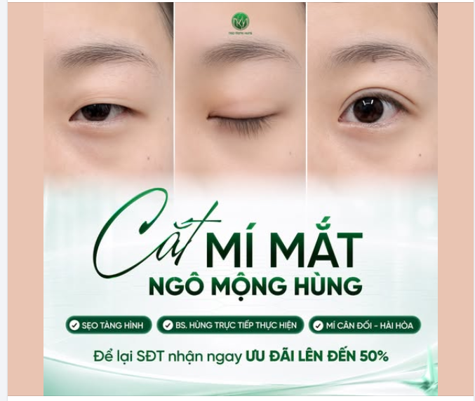 Cắt mí tháng này – Để lại SĐT nhận tư vấn ưu đãi lên đến 50%