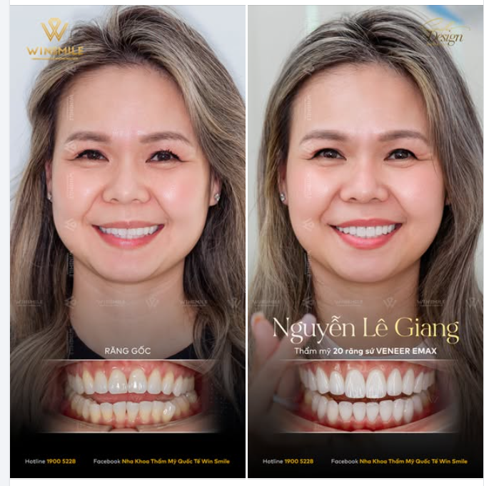 Có những vẻ đẹp vốn đã rất vừa vặn trong mắt số đông, giống như hàm răng nguyên bản của chị Lê Giang.