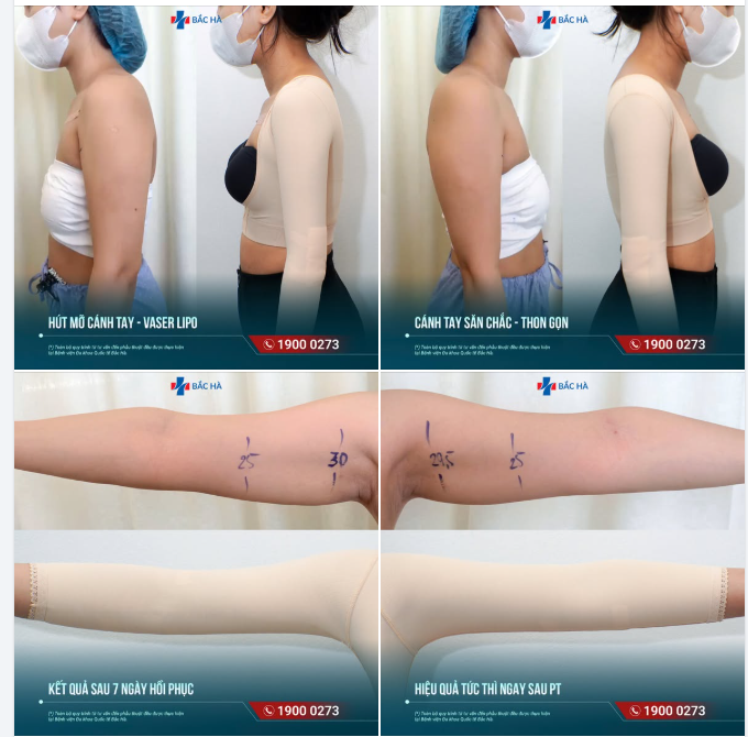TÁI KHÁM SAU 7 NGÀY HÚT MỠ CÁNH TAY