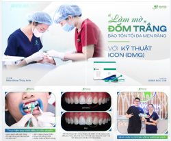 "LÀM MỜ" ĐỐM TRẮNG, BẢO TỒN TỐI ĐA MEN RĂNG VỚI KỸ THUẬT ICON (DMG)