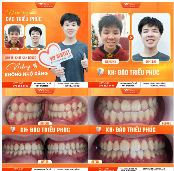 KHỚP CẮN NGƯỢC - SỢ PHẪU THUẬT - SỢ NHỔ RĂNG