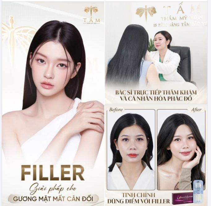 Với filler, điều quan trọng không nằm ở việc tiêm nhiều hay ít mà cần cân chỉnh đúng vị trí.