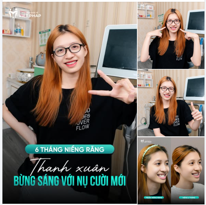 6 THÁNG NIỀNG RĂNG VÀ NỤ CƯỜI RẠNG RỠ TUỔI 24