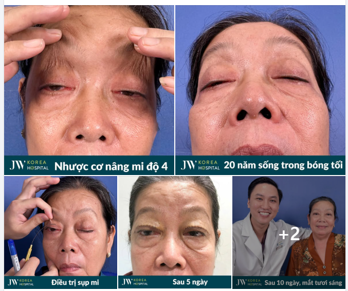 TREO CƠ MẮT, CẮT DA BÁCW CỨU U60 THOÁT CẢNH SỤP MI, TÌM LẠI ÁNH SÁNG SAU 2 THẬP KỶ SĨ J