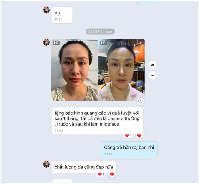 Feedback của bạn Thanh sau 1 tháng căng da Midface cùng Dr Vương.