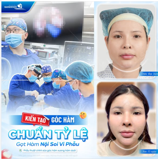 KIẾN TẠO GÓC HÀM CHUẨN TỶ LỆ - GỌT HÀM NỘI SOI VI PHẪU