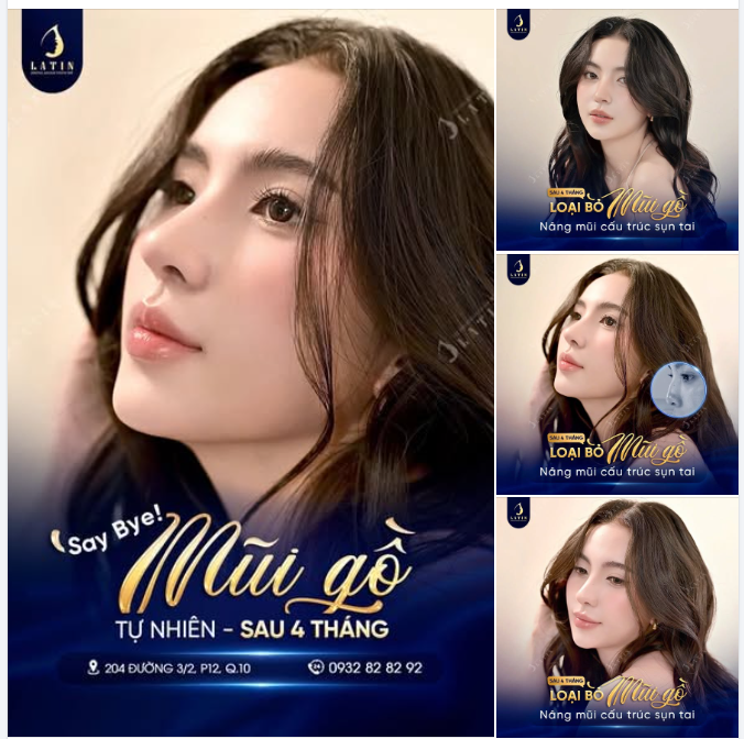 Có một thời, mũi gồ được xem như nét cá tính rất riêng trên gương mặt.