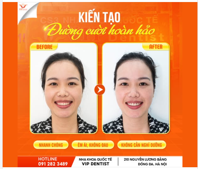 TẠM BIỆT CƯỜI HỞ LỢI – KIẾN TẠO ĐƯỜNG CƯỜI HOÀN HẢO CHỈ SAU 1 LẦN THỰC HIỆN!