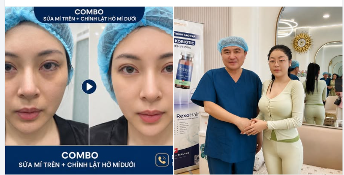 COMBO SỬA MÍ TRÊN + CHỈNH LẬT HỞ MÍ DƯỚI cho bạn gái Việt kiểu Singapore với Dr Vương