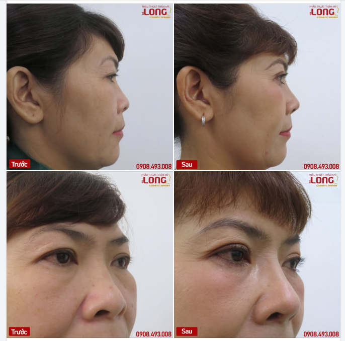 Dáng mũi dành cho phụ nữ tuổi “trung niên”