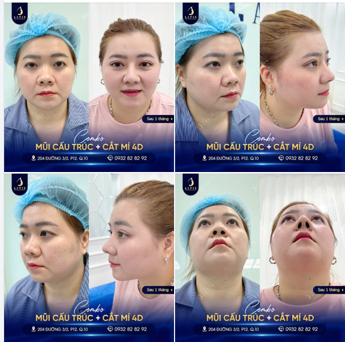 "CHỐT" MÍ 4D, "TẬU" MŨI CẤU TRÚC" – ĐỔI KHUÔN MẶT MỚI, XINH KHÔNG TÌ VẾT