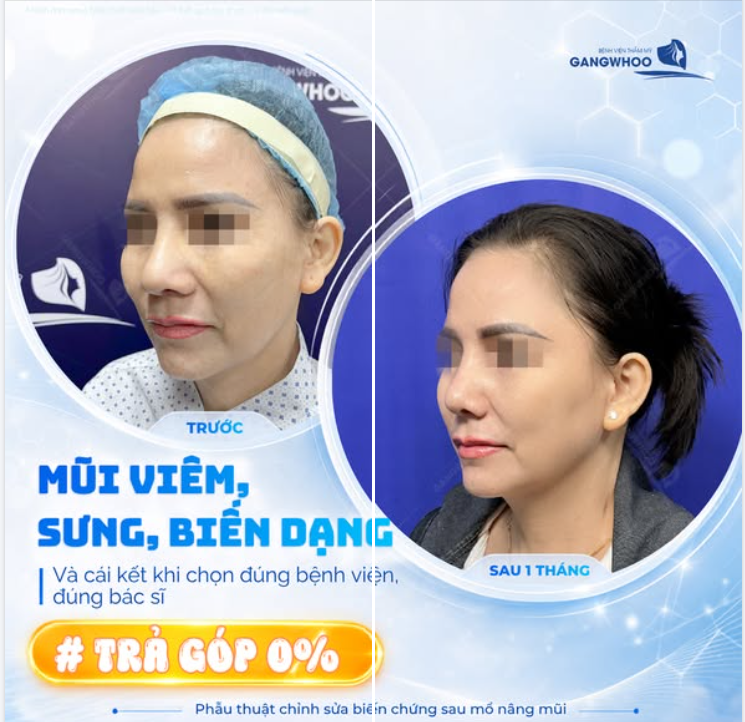 MŨI VIÊM, SƯNG, BIẾN DẠNG