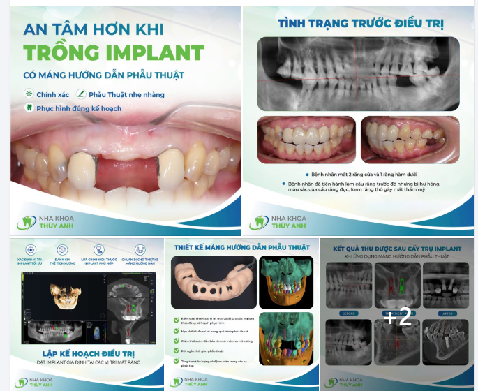 CASE IMPLANT PHỤC HỒI 3 RĂNG MẤT VỚI MÁNG HƯỚNG DẪN PHẪU THUẬT