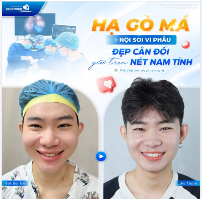 HẠ GÒ MÁ NỘI SOI VI PHẪU - ĐẸP CÂN ĐỐI GIỮ TRỌN NÉT NAM TÍNH