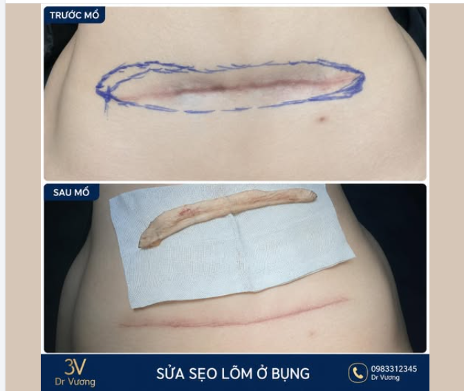 Phẫu thuật tạo hình sửa sẹo lõm bụng với Dr Vương