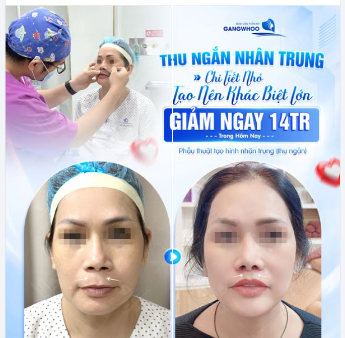 THU NGẮN NHÂN TRUNG CHO CHỊ KHÁCH HÀNG U50