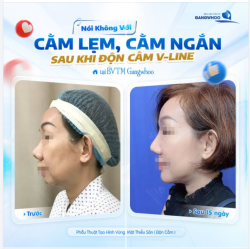 NÓI KHÔNG VỚI CẰM LẸM, CẰM NGẮN