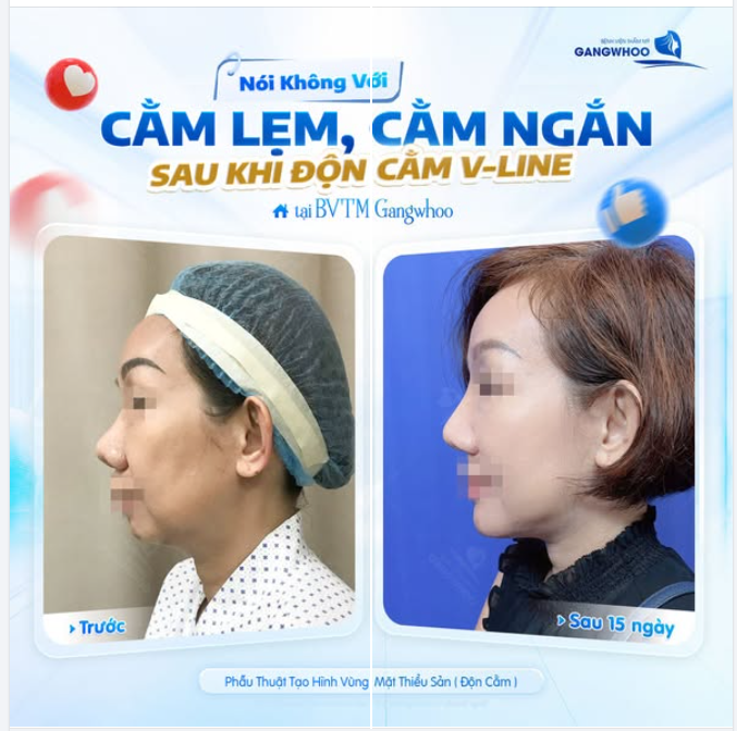NÓI KHÔNG VỚI CẰM LẸM, CẰM NGẮN