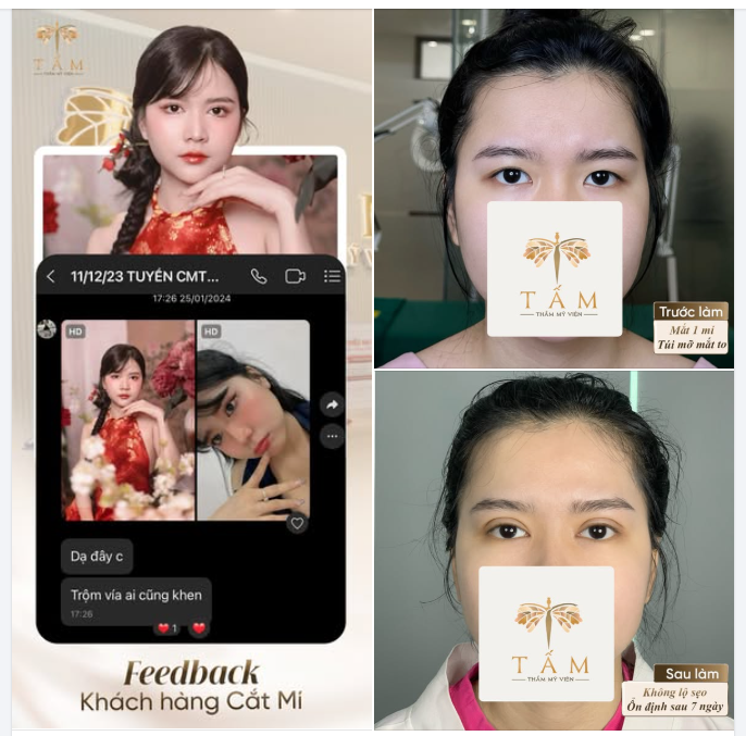 "Trộm vía ai cũng khen" - Feedback "nóng hổi" về đôi mắt mới mới của chị đẹp M.T, với tình trạng nếp mí hiện tại: