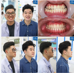 Thay đổi của khớp cắn ngược khi niềng răng là khỏi phải bàn cãi