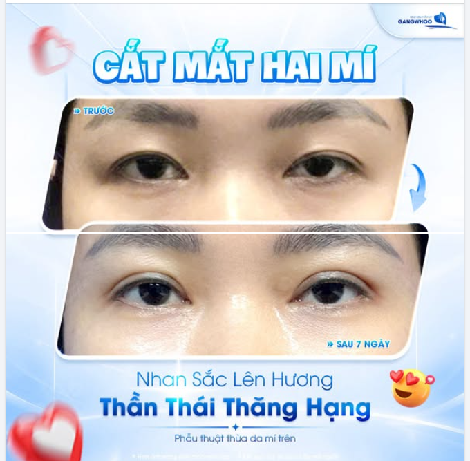 MÍ LÓT, MÍ KHÔNG ĐỀU NHAU