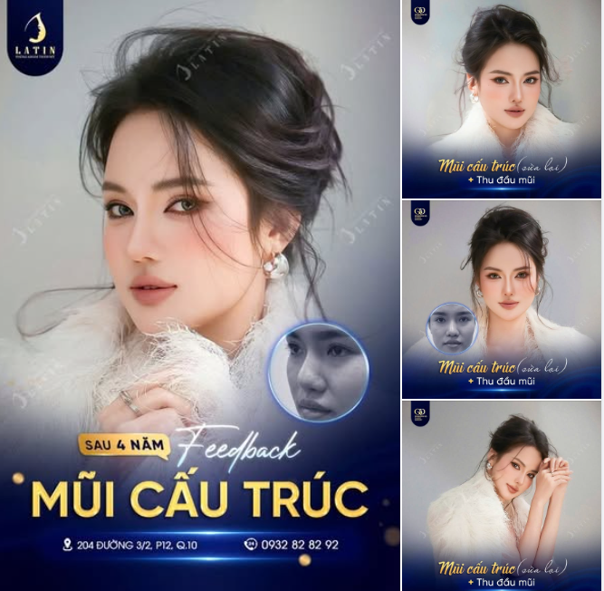 FEEDBACK MŨI CẤU TRÚC SAU 4 NĂM 