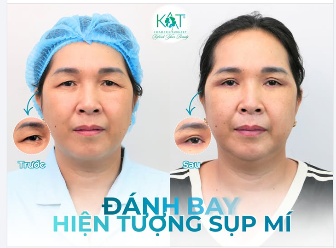 Đừng nghĩ sụp mí chỉ là dấu hiệu của tuổi tác.