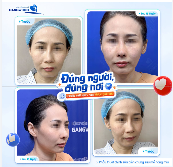 SỬA MŨI ĐÚNG NƠI - ĐÚNG BÁC SĨ