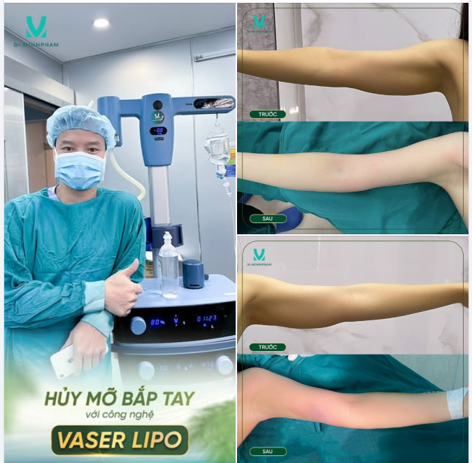 Tạm biệt bắp tay to - Lấy lại cánh tay thon gọn