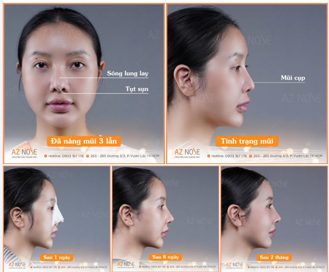 Đã nâng mũi 3 lần, nhưng mỗi lần lại gặp một vấn đề khác nhau.