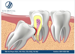 RĂNG KHÔN MỌC LỆCH – ĐỪNG ĐỂ ẢNH HƯỞNG ĐẾN RĂNG SỐ 7