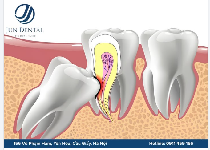 RĂNG KHÔN MỌC LỆCH – ĐỪNG ĐỂ ẢNH HƯỞNG ĐẾN RĂNG SỐ 7