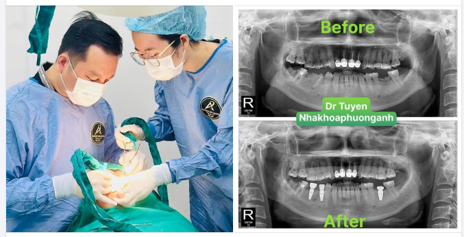 Vật liệu làm implant nha khoa từ gì? có an toàn không?