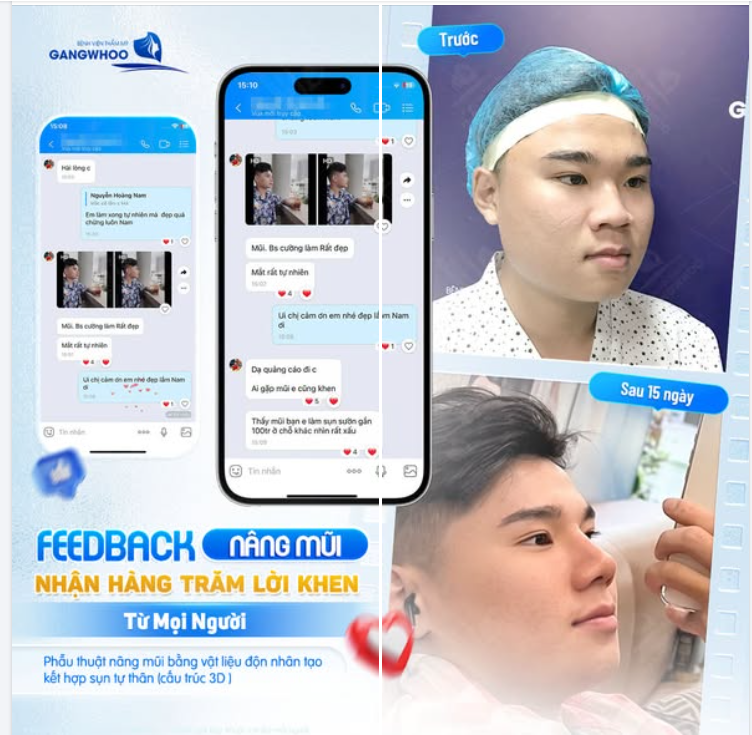 FEEDBACK SAU 15 NGÀY NÂNG MŨI