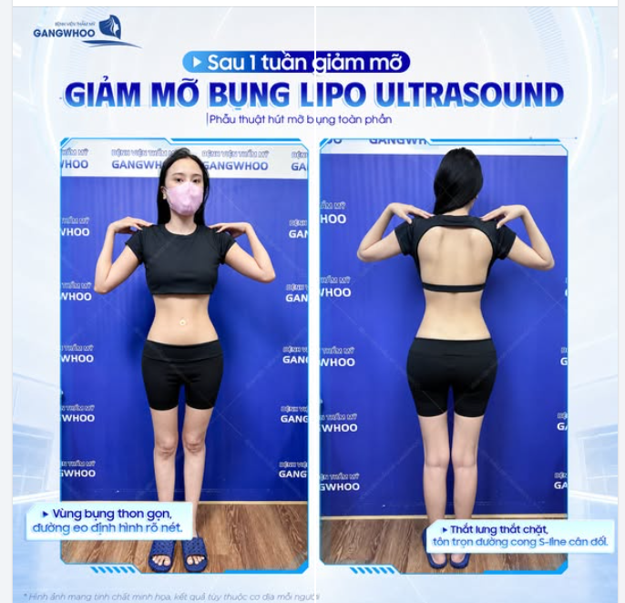 KHI EO THON THAY THẾ CHO NHỮNG LẦN CHE BỤNG