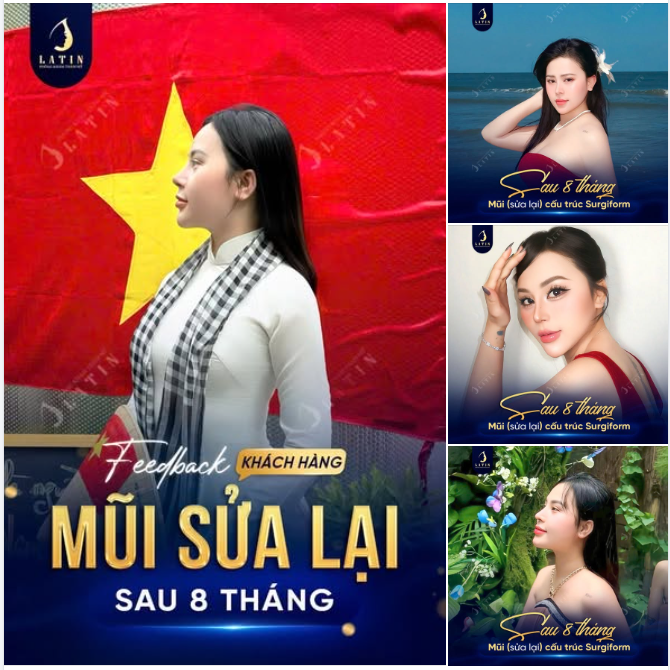 FEEDBACK MŨI SỬA LẠI SAU 8 THÁNG