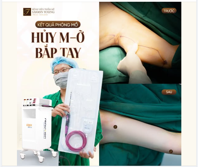 CÔNG NGHỆ J - PLASMA TRONG HỦY M..Ỡ BẮP TAY CÓ TÁC DỤNG NHƯ THẾ NÀO?
