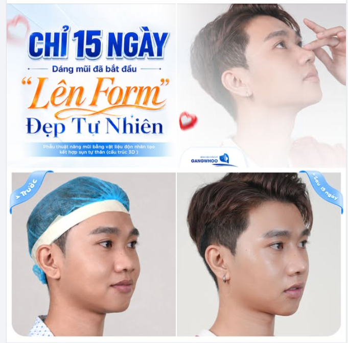CHỈ 15 NGÀY DÁNG MŨI ĐÃ BẮT ĐẦU LÊN FORM ĐẸP TỰ NHIÊN