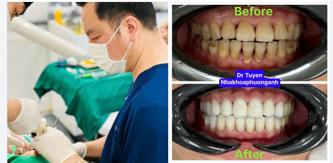 Chỉ cần nhìn hai bức ảnh Before After, bạn sẽ thấy sự khác biệt.