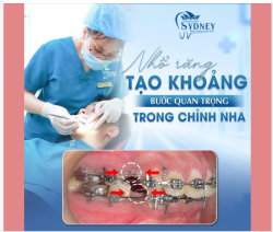 NHỔ RĂNG TẠO KHOẢNG - BƯỚC QUAN TRỌNG TRONG CHỈNH NHA