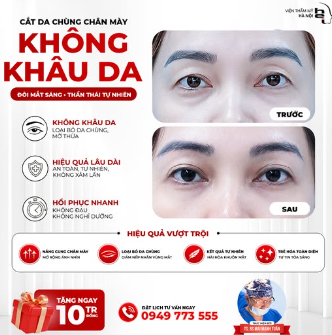 CẮT CHÙNG DA CHÂN MÀY: XOÁ SỤP MÍ LÃO HÓA – KIẾN TẠO TƯỚNG MẠO PHÚ QUÝ