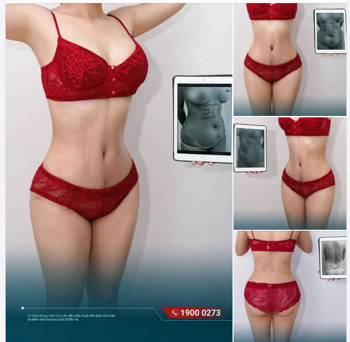 20 NGÀY SAU HÚT MỠ SIẾT EO 360 — VÒNG EO ĐÃ THAY ĐỔI ĐẾN ĐÂU?