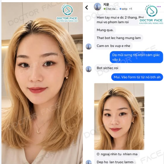 Feedback từ chị khách Hàn Quốc sau 2 tháng nâng mũi