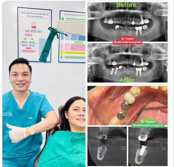 Ca cấy ghép Implant đầu tiên của 6 tháng cuối năm. KPI của bác sĩ trong năm nay sẽ đi 8-10 nước trên thế giới. Trồng mới 500 - 700 trụ Implant tái tạo nụ cười và sức khoẻ răng miệng cho BN.