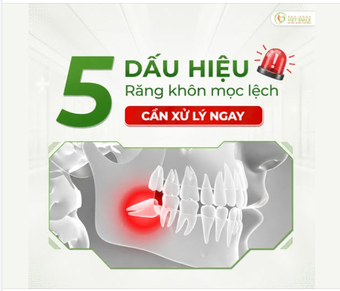 5 DẤU HIỆU CẢNH BÁO RĂNG KHÔN MỌC LỆCH BẠN KHÔNG NÊN BỎ QUA