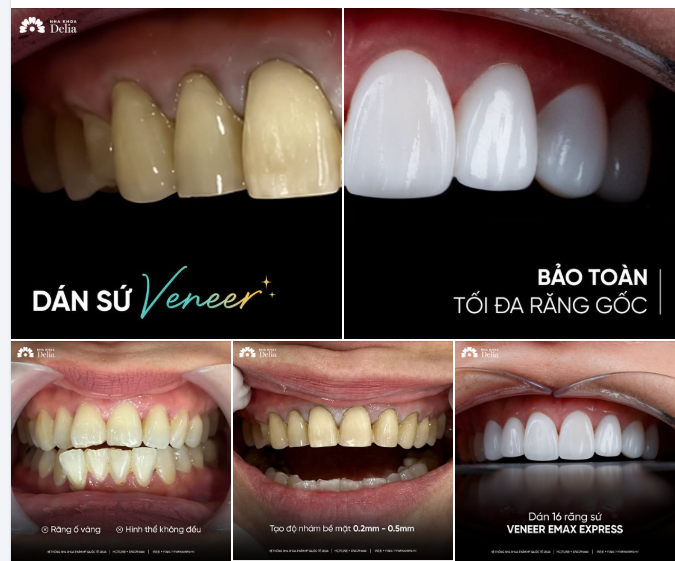 Dán sứ Veneer: Giải pháp bảo toàn tối đa răng gốc