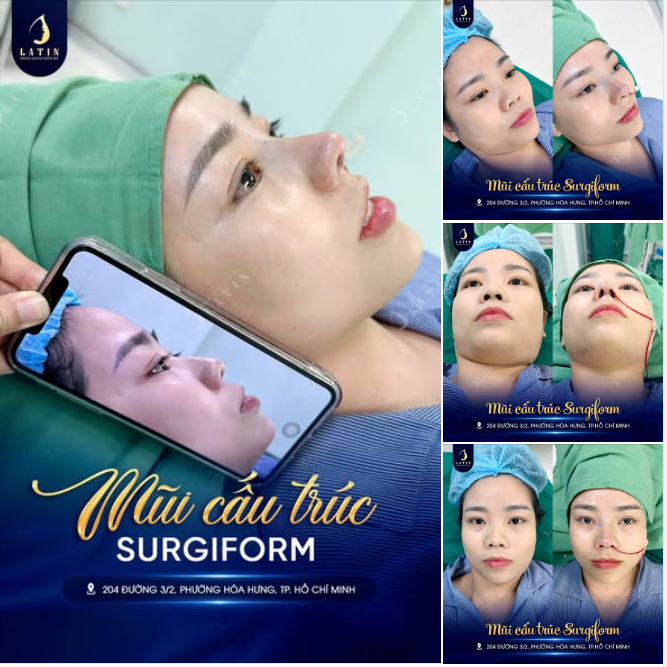Từ dáng mũi thấp, ngắn và bè ngang, mũi mới sở hữu phần sống cao, đầu mũi vươn gọn và đường nghiêng rõ nét ngay sau thực hiện.